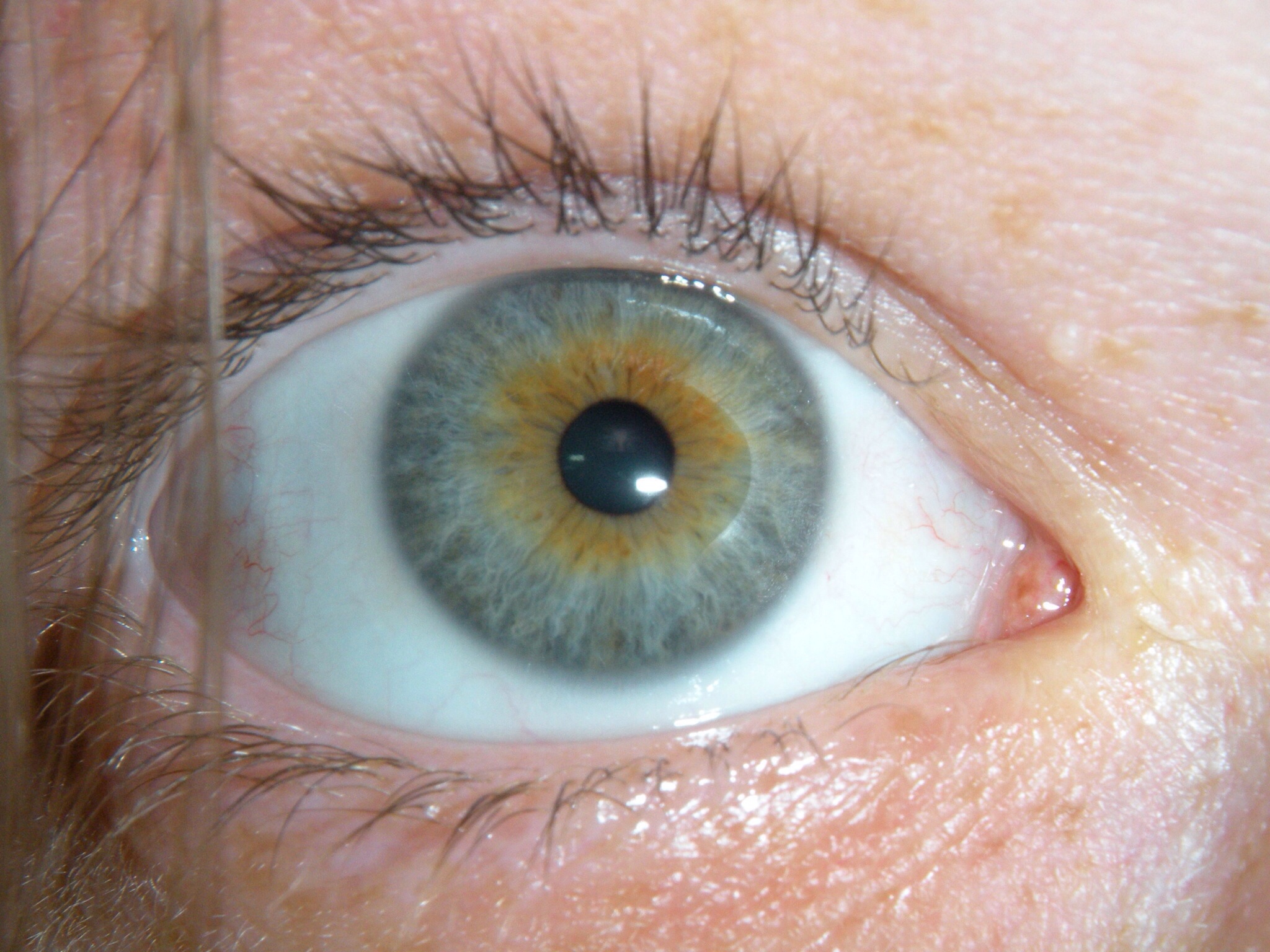 Разная радужка. Центральная гетерохромия глаз. Центральная гетерохромия зеленый Карий. Центральная гетерохромия зрачок. Гетерохромия Радужки глаз.